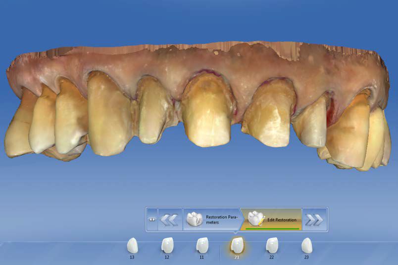 Sirona CEREC AC — цифровая система с камерой CEREC OMNICAM