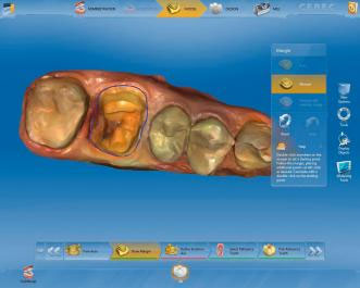 Sirona CEREC AC — цифровая система с камерой CEREC OMNICAM