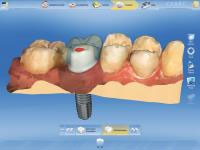 Sirona CEREC AC — цифровая система с камерой CEREC OMNICAM