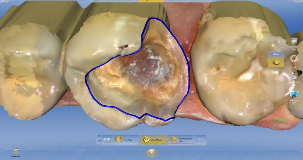 Sirona CEREC AC — цифровая система с камерой CEREC OMNICAM