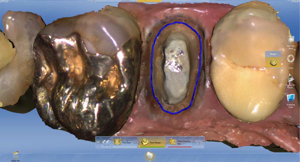 Sirona CEREC AC — цифровая система с камерой CEREC OMNICAM