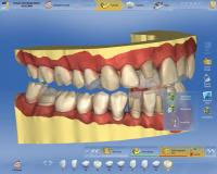 Sirona CEREC AC — цифровая система с камерой CEREC OMNICAM