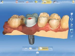 Sirona CEREC AC — цифровая система с камерой CEREC OMNICAM
