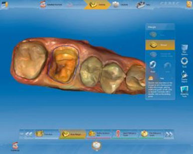 Sirona CEREC AC — цифровая система с камерой CEREC OMNICAM