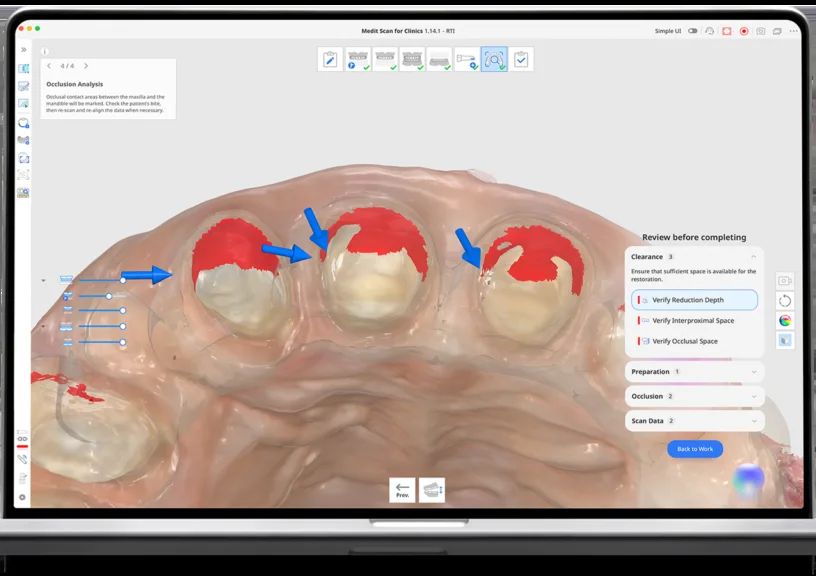 Realtime Intelligence подсвечивает проблемные участки 3D-скана препарированных зубов