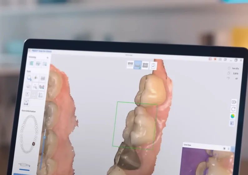Программа Medit показывает 3D-модель зубов, снятую сканером i700